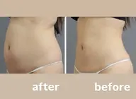 ☆エリア初☆TVやSNSで話題の冷却4cup&次世代EMSで気になるお腹周りにくびれを作りリバウンドなしダイエット♪