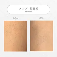 🌿メンズ足脱毛