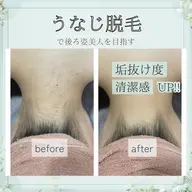 🌙学割U24限定🌙うなじで差がつく⭐ポツポツ毛穴は卒業！推し活/前撮り/成人式/イベント前準備
