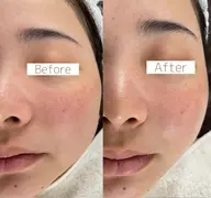 【速攻小顔】お肌の代謝upさせながらフェイスラインスッキリ!2台の機械を使ってお顔を引き上げます⭐︎