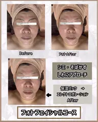 光フェイシャル　8,000円 →初回限定5,000円