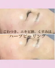 お肌が生き返る！ハーブピーリング𓂃