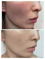 【赤み・つっぱり感集中ケア】しつこい赤みを鎮静！潤いふっくらツヤ肌♡