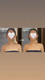 ハイパーナイフ小顔韓流モデルコース✨