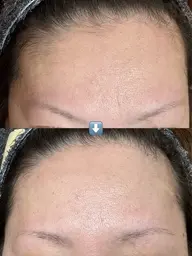 【新メニュー】気になる人にはキニナル産毛WAX脱毛❕限定価格 ¥2000円 (前髪生え際産毛のみ)