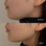 【キュッと小顔】徹底Vライン形成リフトUP+弾力強化 ◆韓国IR管理 / 切らない脂肪吸引