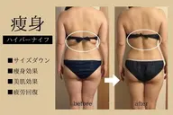 ≪特価★お腹二の腕背中≫ハイパーナイフ+ マッサージ60分¥ 13000→ ¥ 6800