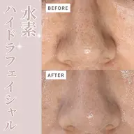 【全顔毛穴洗浄🫧】水素水ハイドラフェイシャルフルコース💞パック付き🫶🏻