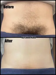 「メンズ」VIOブラジリアンワックス