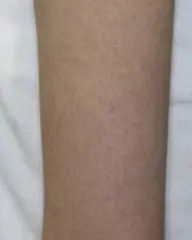 【二の腕ブツブツザラザラケア】剥けないハーブピーリング＋生酵素