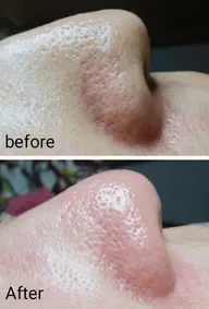 【🆕✨毛穴洗浄&引き締めフェイシャル】【メンズ大歓迎⭕️】