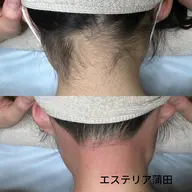 うなじW脱毛+もみあげW脱毛 ¥8000⇒¥7000