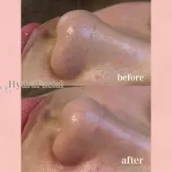 【大人気】🫧お顔丸ごと毛穴洗浄🫧|水光肌ケア|ハイドラフェイシャル 肌質改善・黒ずみ/ざらつき/ニキビ卒業!!