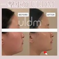 韓国最新機器ULDM✖️白玉肌管理✖️小顔コルギ　90分/真皮ケア◎一撃小顔‼️みずみずしい艶肌に🩵