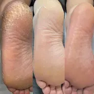 エンザイム角質ビットケア®︎追加施術（メンズOK）