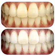 お子様でも痛くない！セルフホワイトニング🦷✨ペア割(お二人様以上でのご来店)  お一人様8分×2セット