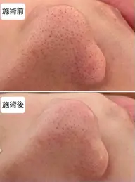 小鼻のザラザラがつるつるに。毛穴洗浄、デコルテマッサージ、ヘッドマッサージ付