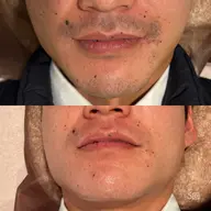 【朝ラク🔥】ヒゲ脱毛！デザイン髭OK／清潔感UP✨