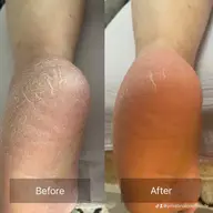 角質オフ❣️ 炭酸の力でつるすべ素足艶かかとリバイバルケア by カーボキシー🫧