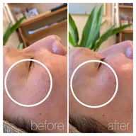 【ハリ、ツヤ激変!肌質改善】 ハーブピーリングでツヤ肌を手に入れよう♪