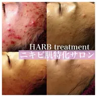 【平日限定】\ニキビ・肌荒れ/特化ハーブトリートメント★幹細胞フェイシャル