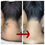 【ミニモ限定】人気No.1☆うなじ脱毛(爆抜け追加+500円)