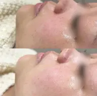 💎✨フェイシャル【人気No.1】✨💎毛穴ピーリング＋光フェイシャル＋美容液導入💖ハリ/ツヤ/くすみ/リフトアップ❕