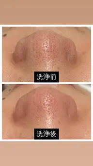 【ダウンタイム・剥離なし⠀】ハイドラフェイシャル・水流ピーリング