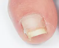 巻き爪改善テープ（爪を矯正し、痛みを緩和します）🦶✨