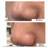 毛穴洗浄フェイシャル✨全顔の毛穴の汚れをピカピカに