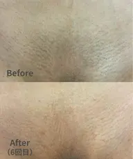 【女性人気No.2】効果重視！VIOつるすべ脱毛（清潔感UP）￥2,980（女性のみ）