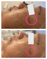 40代大人女性のエイジングケア★業界最多幹細胞 基底膜のケアフェイシャル+小顔筋膜リフト90分