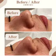 毛穴洗浄ハイドラフェイシャル《ビタミン導入付き》