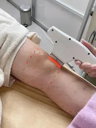 【平日限定】【IPL脱毛】　脚全体・指甲​〜​太もも脱毛