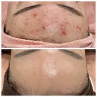 🌿【ハーブピーリングで素肌美人へ】🌿