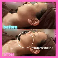 【クリスティーナ/フォーエバーヤング】施術直後のリフトアップがまるで照射後のような小顔効果🔥ハリ、弾力のあるお肌へ✨