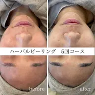 【毛穴／くすみ改善✨】剥けにくい優しいハーバルピーリング🌿