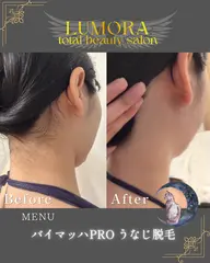 【うなじ脱毛】ブライダル・成人式・前撮り前に🤍🕊💗