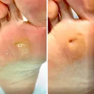 【施術風景を撮影させてくれる方限定】顔出し🆖も大丈夫です。【トータルフットケア】タコ、ウオノメ、踵のひび割れ