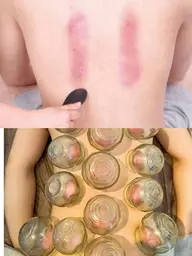 【不眠/倦怠感が強い方】オイル+カッサ+カッピング90分♪(全員別途シーツ代300円)