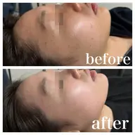 【毛穴/いちご鼻/ニキビ】ハーブピーリング+高級美顔器セルキュア使用✨毛穴洗浄|ツルスベ肌へ