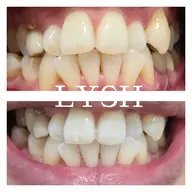 当日予約🆗セルフホワイトニング🦷✨約45分でトーンアップ‼️