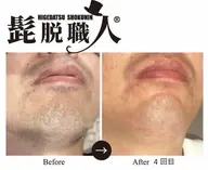 🚹🖤メンズ髭脱毛【人気部位/リピート率No.1】期間限定✨️口コミ割✨️