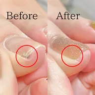 【巻き爪の方にオススメ】巻き爪ケア