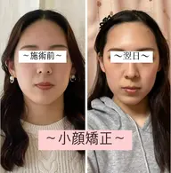 モニター様【圧倒的小顔美人へ】痛くない小顔矯正40分 小顔/エラ/歪み/むくみ/たるみ改善💎 ¥9500→¥6000