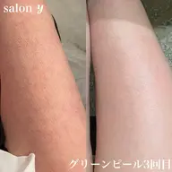 グリーンピールボディ1day(2パーツ)【体のざらつきをスベスベに】