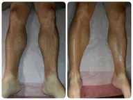 脚丸ごとワックス脱毛or光脱毛どちらか