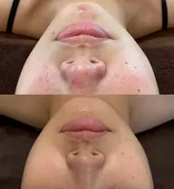 1日1人限定premium✨ハーブピーリング🌿毛穴洗浄