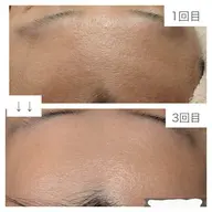 【ミニモ限定REVIハーブピーリング】"乾燥特化"通常価格¥11000→¥7500