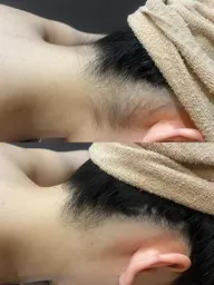 脱毛を始めたい方必見✨【うなじ脱毛】最新機器で即実感✨シェービング付きでデザインも安心😌後ろ姿も怖くないうなじ美人💫